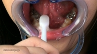 開口器具つけて歯磨きベロ磨き　口内観察