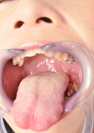 開口器具つけて歯磨きベロ磨き　口内観察