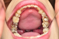 「歯」口内画像写真集　2名分