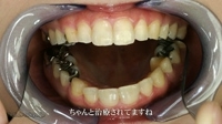 歯観察（写真付き）　つばきチャン篇